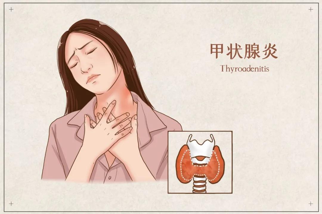 甲状腺患者越来越年轻化 做好这3点方能避免